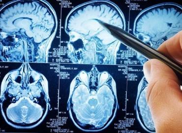 Quais os sintomas do tumor cerebral?